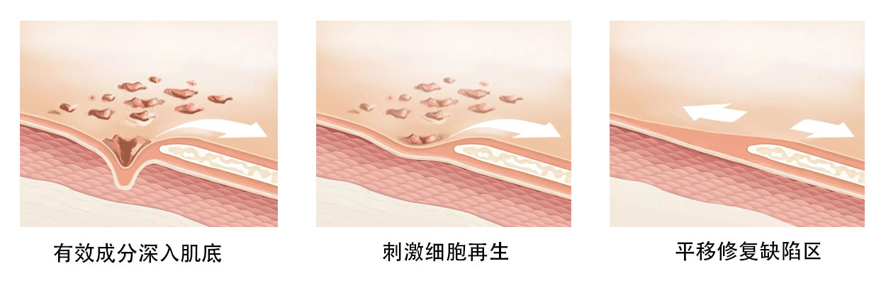 皮肤激光美容后如何护理,激光术后皮肤护理攻略