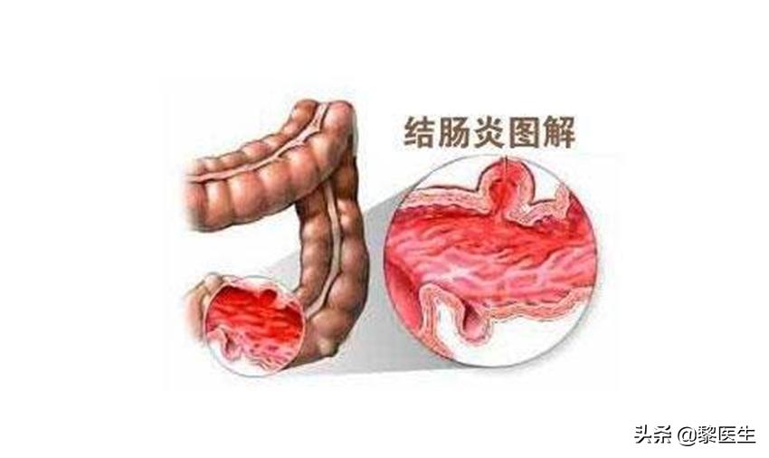 安倍晋三溃疡性结肠炎复发辞职,安倍晋三患溃疡性结肠炎多少年
