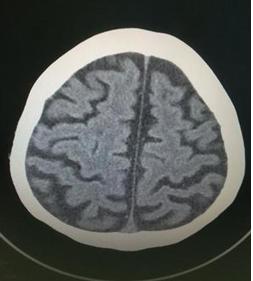 怎么预防脑萎缩最好,有预防脑萎缩的预防针吗