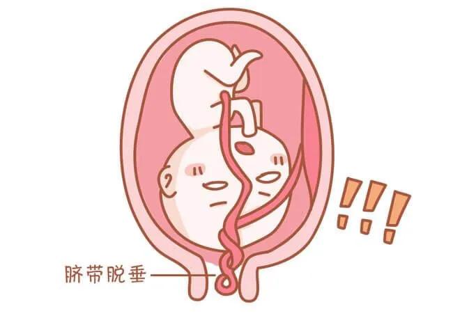 糟了!胎儿脐带掉出来了!