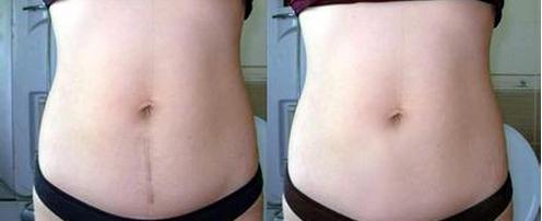 月薪四万月嫂总结:超全产后伤口护理指南,顺产、剖腹产全包含