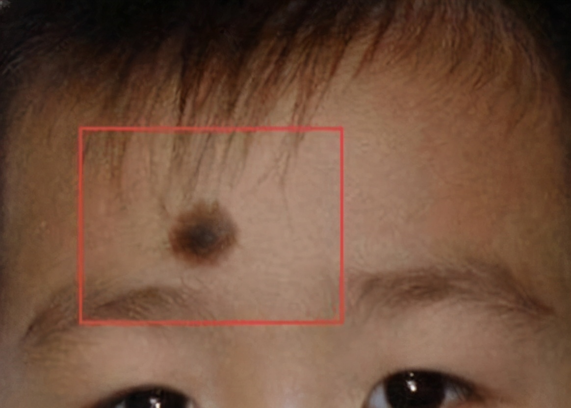 上帝吻过的脸胎记,上帝的吻痕