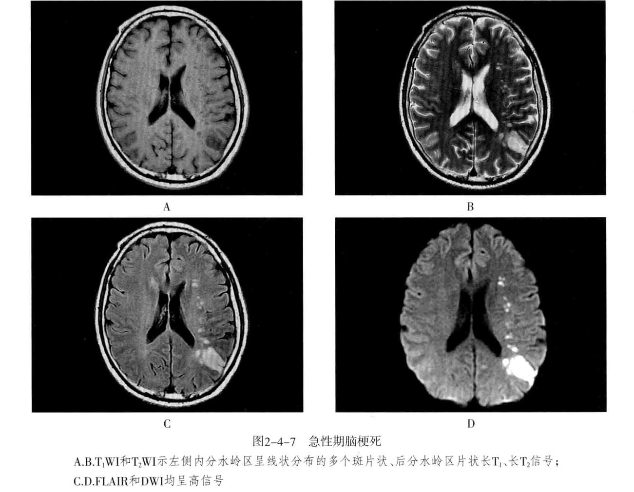 颅内血管轻度狭窄诊断标准,颅内血管先天变异影像