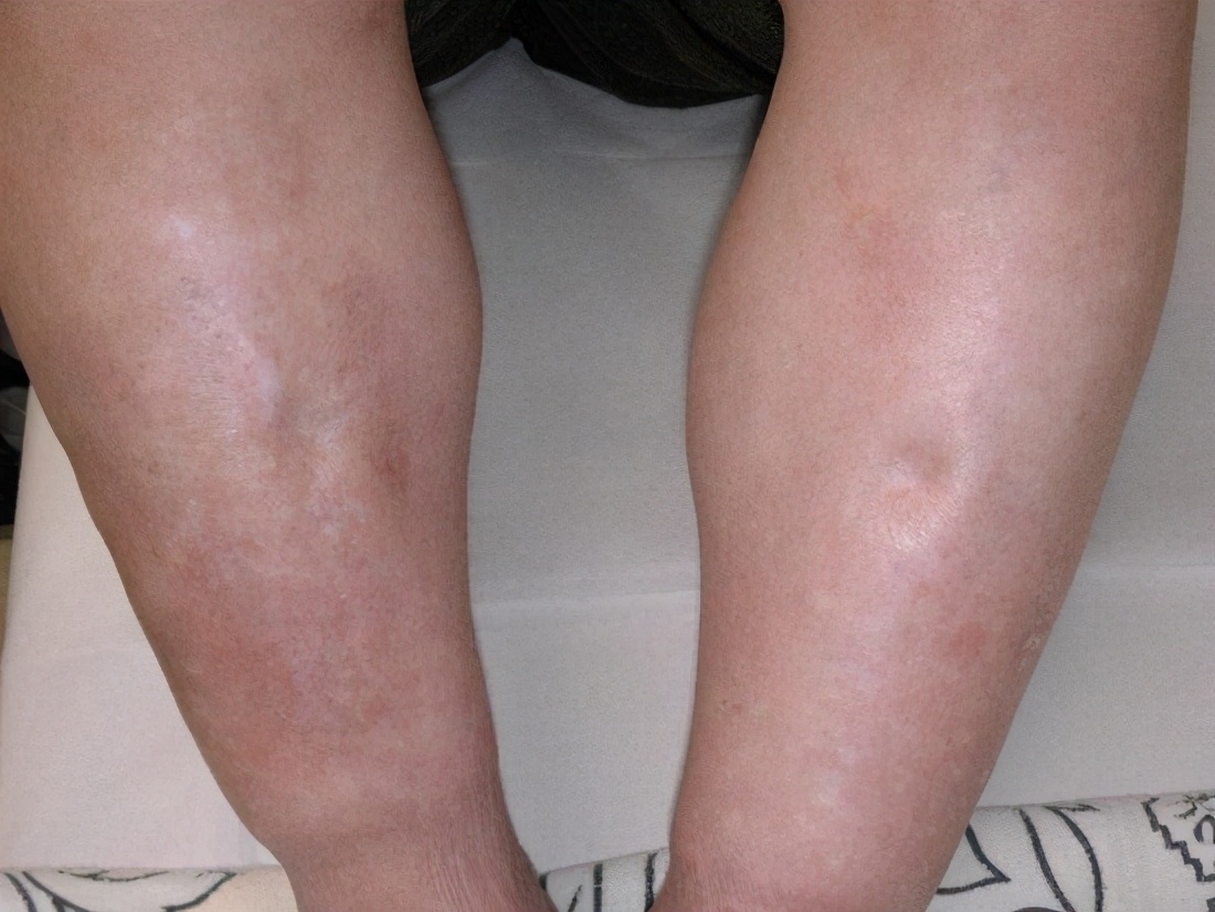 糖尿病人有一只脚面麻怎么回事,糖尿病小腿上有一块肉摸着很痛