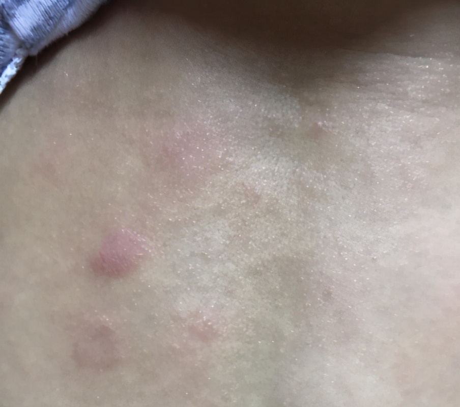 门诊案例｜人的好多病是吃出来的，治皮肤病先调理脾胃