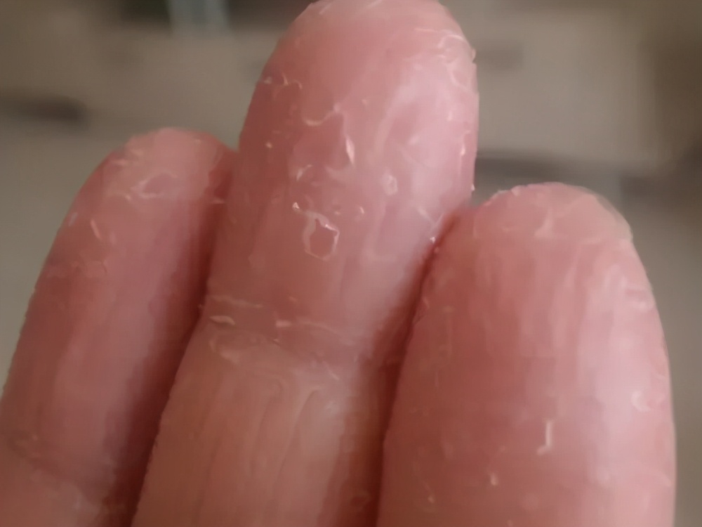 痒痒痒！身上出现这种小水疱，千万别戳破