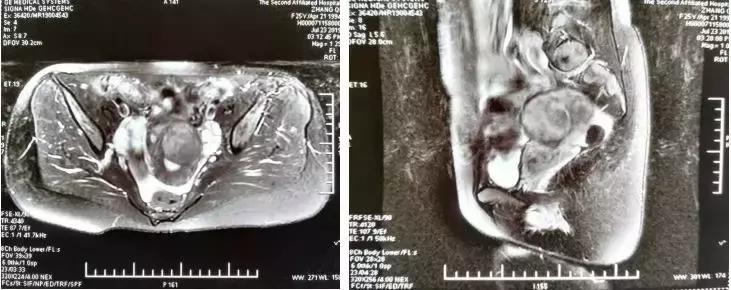 赞！不开刀不流血就把手术做了，赤峰市肿瘤医院迈入微无创时代