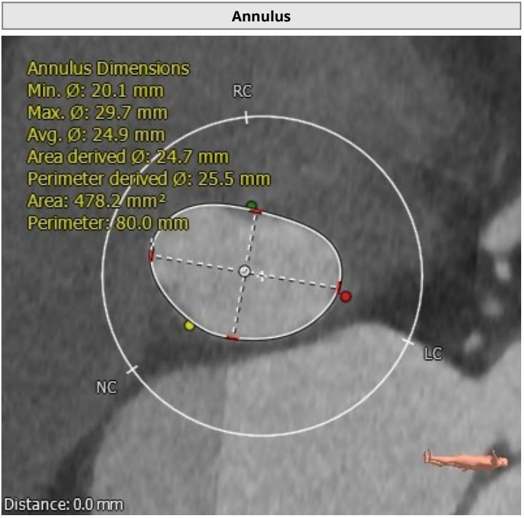 微创人工主动脉瓣膜置换术,微创介入主动脉瓣膜置换术