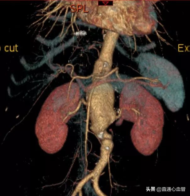 腔内“八爪鱼技术”治疗胸腹主动脉瘤！上海仁济医院血管外科叶猛团队自制“触角”完成高难度腔内隔绝术