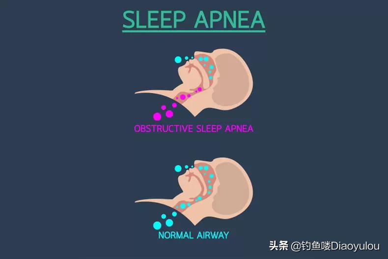 打鼾和床垫有关系吗,睡觉打呼噜用什么床垫最好