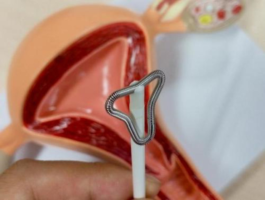 带环会怀孕的宝宝能要不,带环怀孕的孩子到底能要不能要