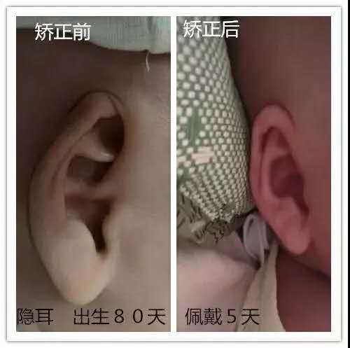 耳廓畸形高考生体检怎么办,二度耳廓畸形矫正方案