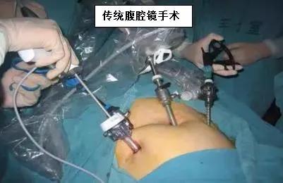 沈阳经脐弹孔腹腔镜手术,妇幼经脐单孔腹腔镜