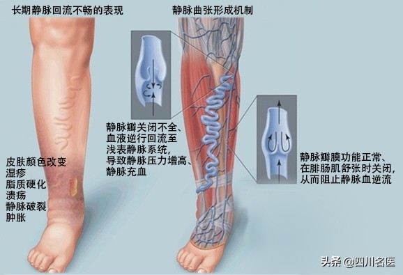 静脉曲张的致残率,静脉曲张最终会是什么结局