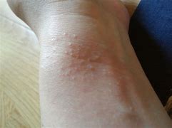 中药熏蒸熏完两次的效果,中药熏蒸吸入疗法