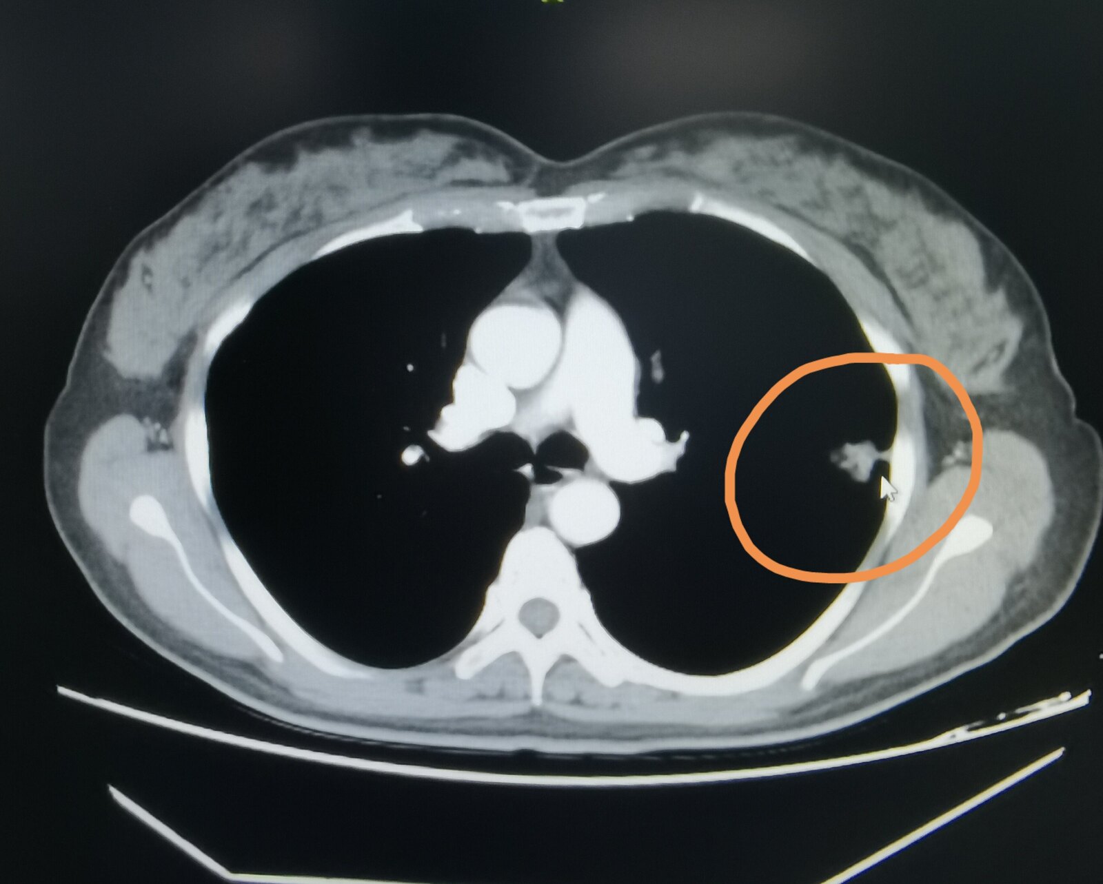 刘懿博士说肺癌,刘懿说肺结节一二三四五