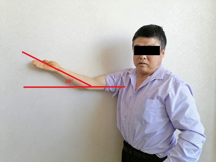 肘关节僵硬手术松解后一直有积液,肘关节僵硬异位骨化必须做松解吗