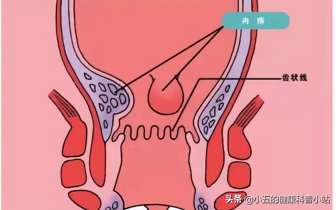 得了痔疮的人平时应该如何护理?除药物和手术治疗外还需注意6点