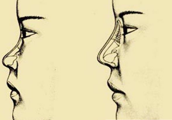 “女看眼,男看鼻”,塌鼻梁的男生如何改善?