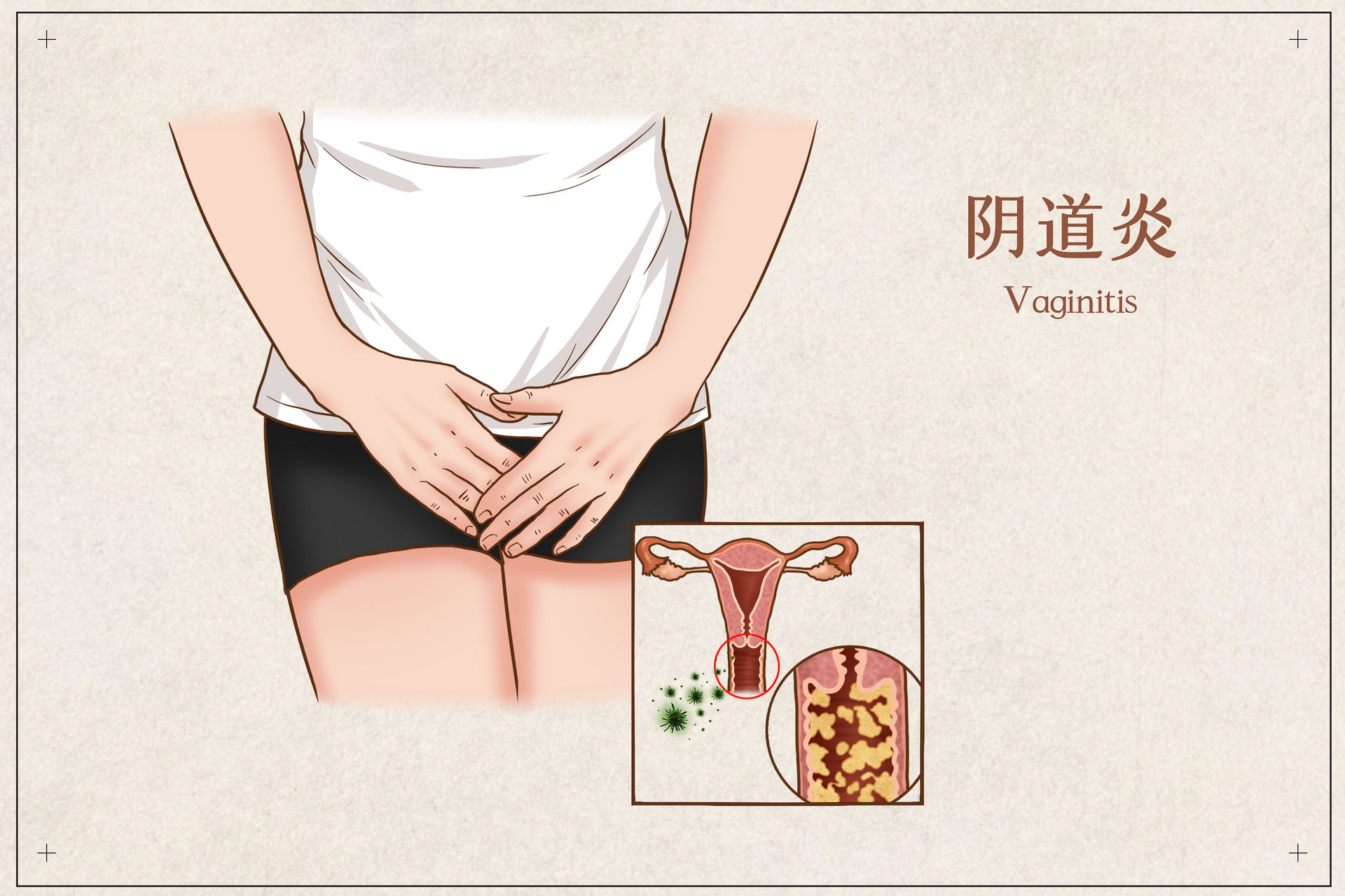 女人容易得妇科病的几个原因,已婚妇女如何避免妇科病