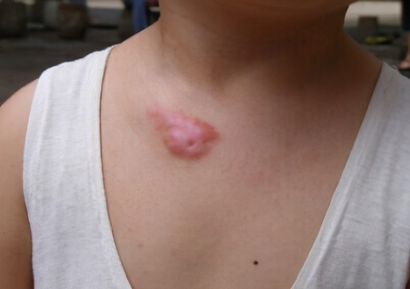 疤痕疙瘩里面有炎症,疤痕感染了硬疙瘩涂什么药能软化