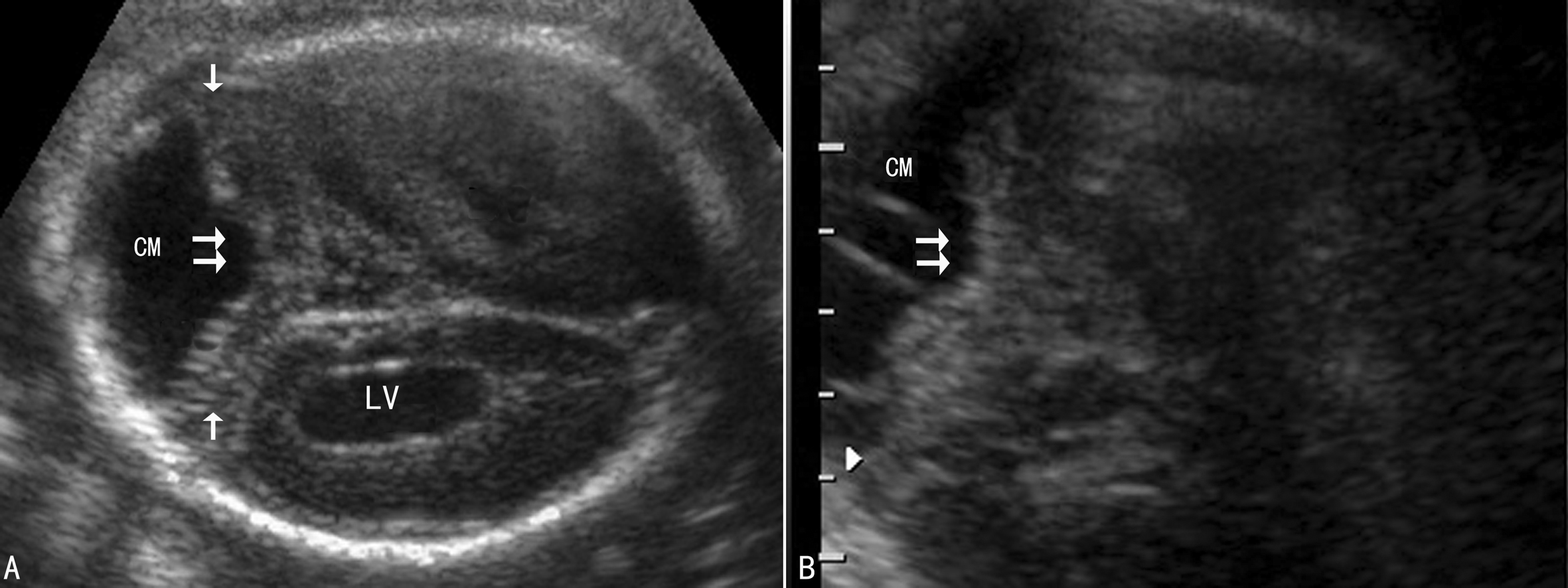 胎儿颅脑中线异常的超声诊断思路,胎儿颅内结构异常超声图片