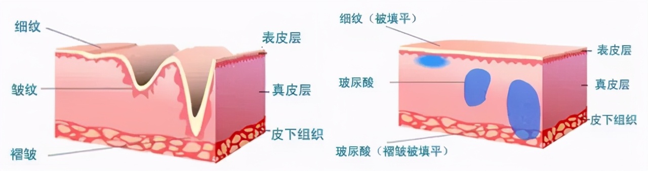 鱼尾纹至少有几条,鱼尾纹和眼角纹的区别图解