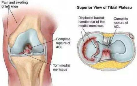 骨科膝盖积液,骨科积水怎么办