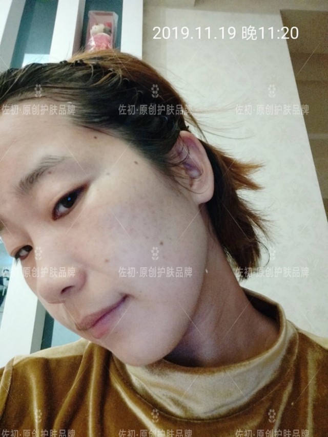 生完孩子烂脸,生完孩子脸上垮了怎样处理