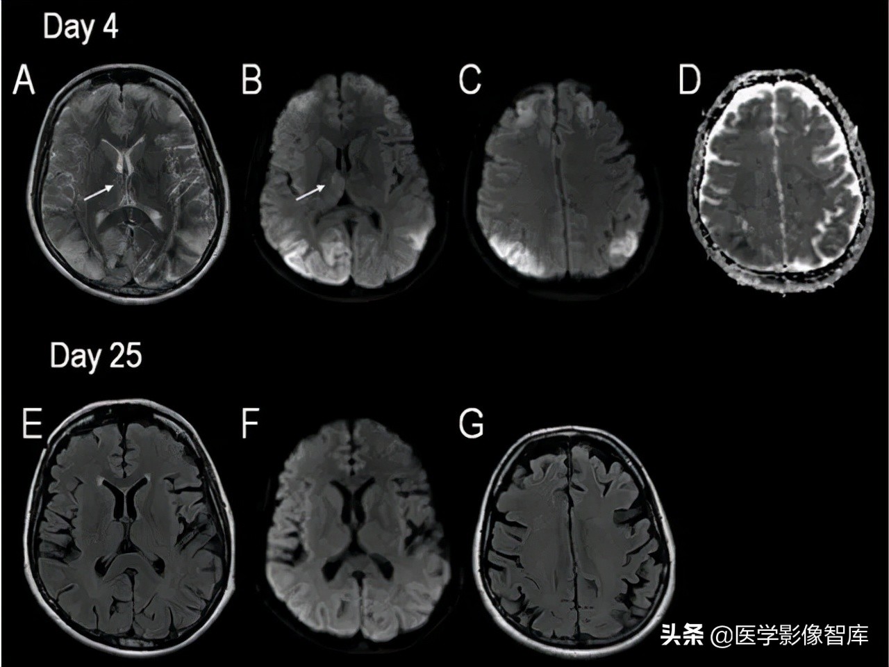双侧额叶皮层区dwi偏高是什么意思,颅内dwi高信号病变