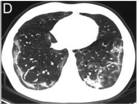 磨玻璃阴影怎么处理,磨玻璃阴影
