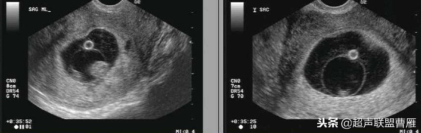 内见卵黄囊,卵黄囊肿瘤