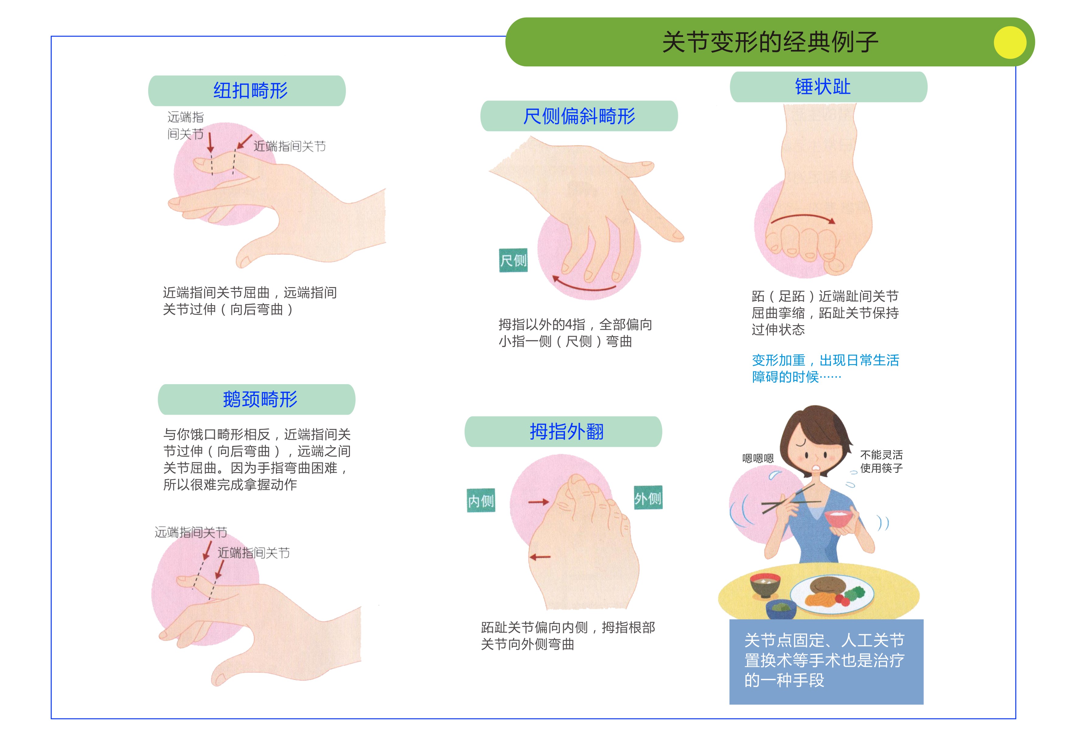 骨关节炎痛风和类风湿都有何症状,痛风关节严重畸形患者能活多久