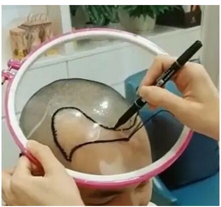 脂溢性脱发怎么治疗最有效,脂溢性脱发防脱生发的方法