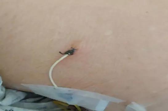 小引流，立大功！他们将微创技术带到基层