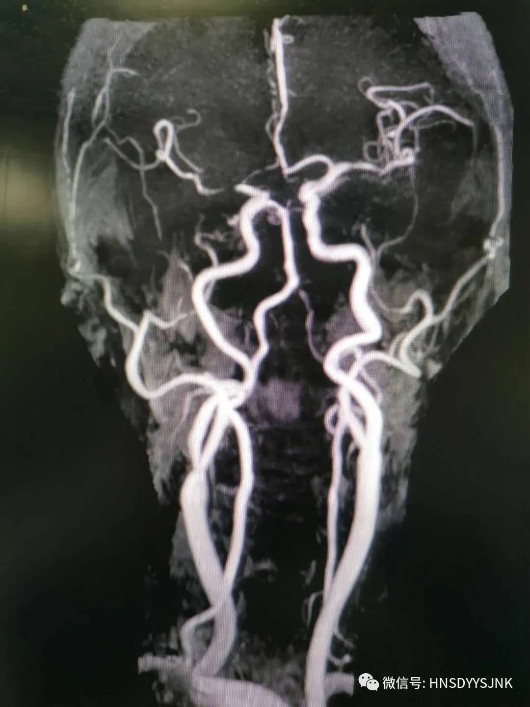 战疫不可掉以轻心,脑卒中为什么4到6小时适合溶栓