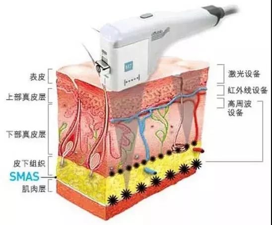 超声刀能抚平皱纹吗,超声刀让人更快衰老吗