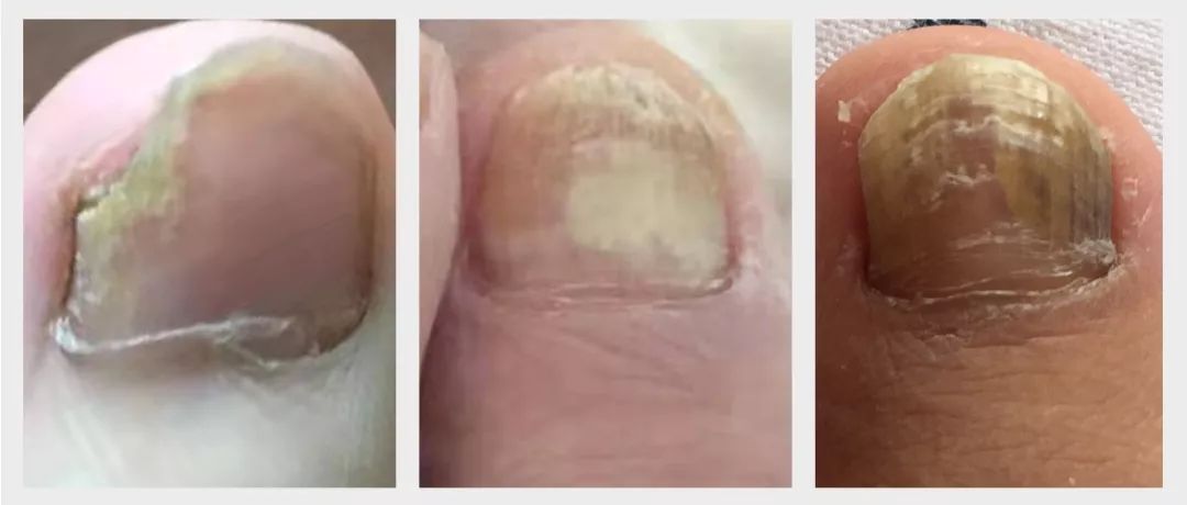 孙叔公治灰指甲有效吗,孙叔公治甲周疣有用吗