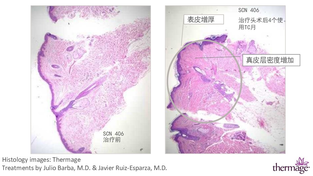 热玛吉真的会有效果吗,热玛吉到底有没有效果