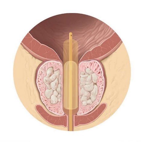 明明感觉有尿却又无法排出来,尿潴留怎么促进尿排出