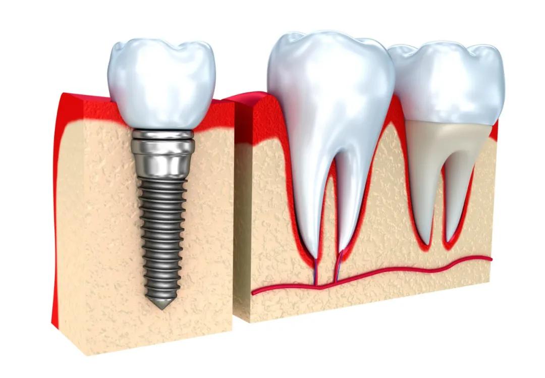 人民日报点评种植牙,人民日报修复牙齿