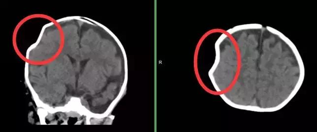 小孩颅脑损伤患者应如何处理,颅脑疾病的预防