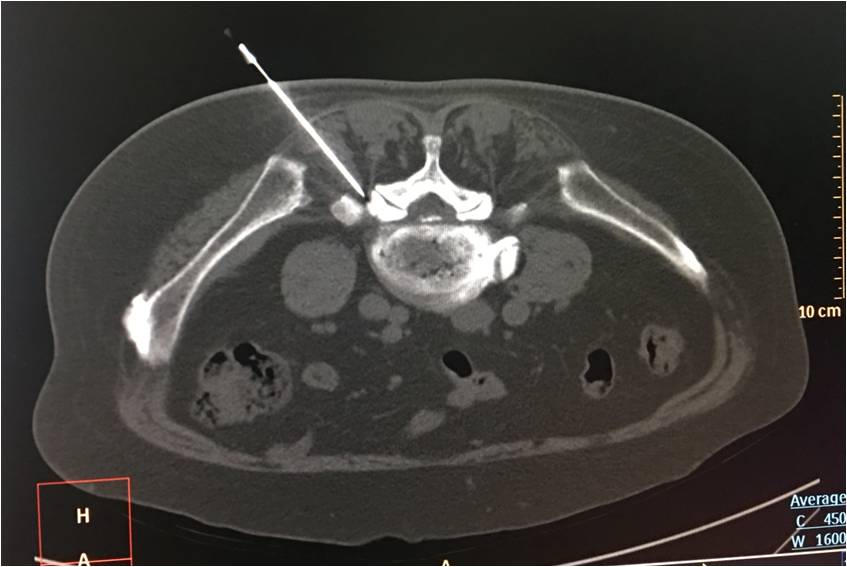 极外侧型腰椎间盘突出微创治疗,超声可视化针刀治疗腰椎间盘突出