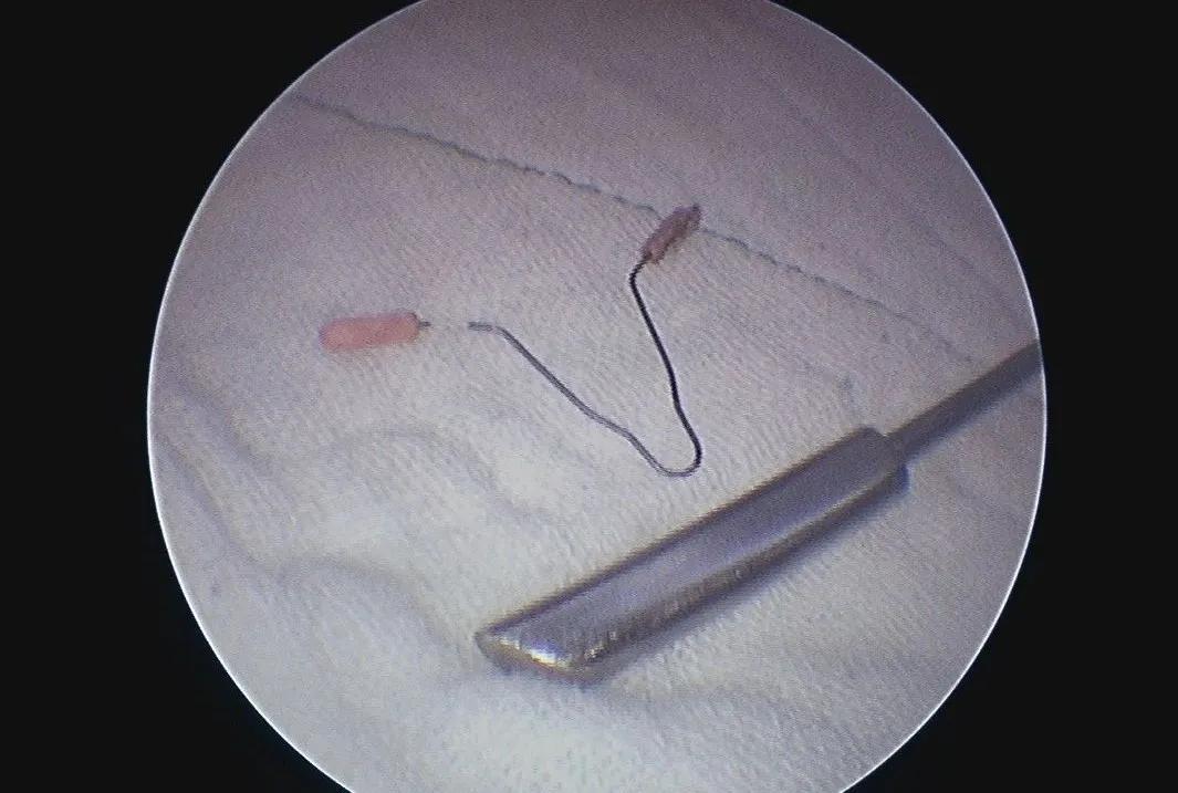 腹腔镜手术取节育环,节育环取出手术