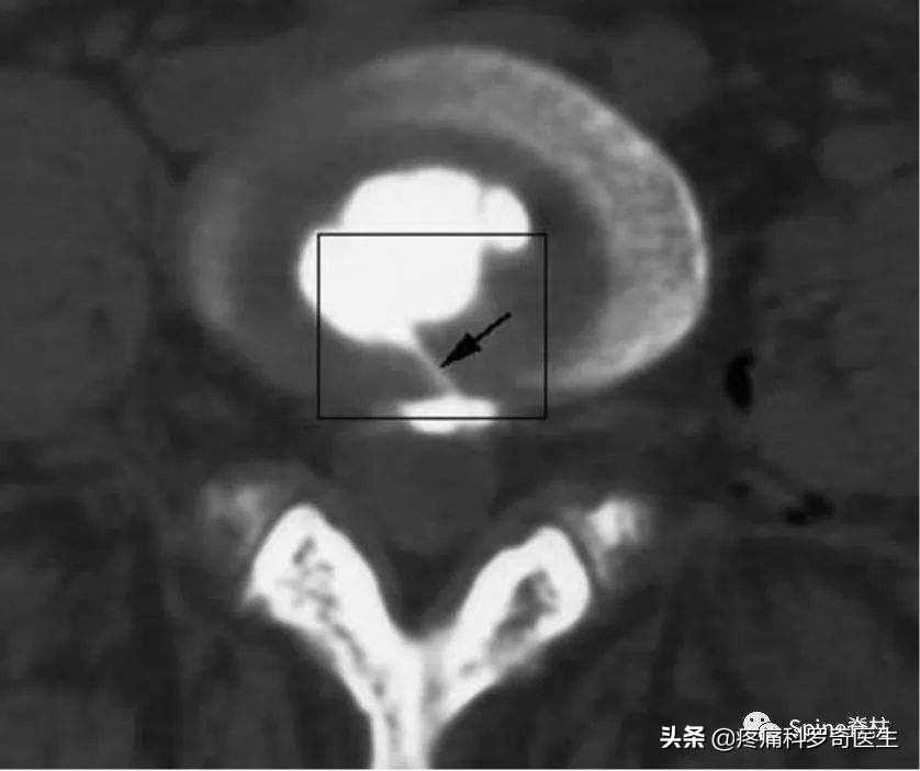 腰痛往下弯就痛是什么原因引起的,为什么我的腰部一直酸疼