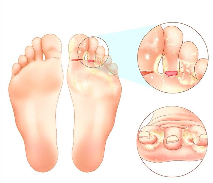 一双袜子就能解决的问题,一双袜子穿久了脚臭怎么办