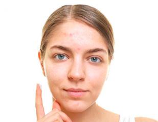 有什么祛痘印的方法,祛红痘印最好的方法