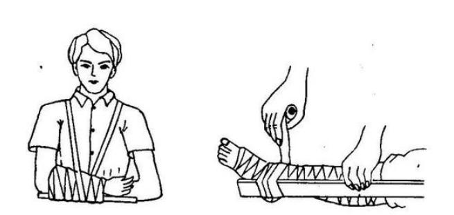 肋骨骨折怎么紧急处理,紧急情况下骨折怎么自救