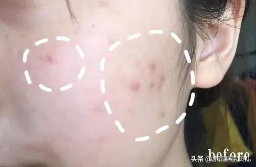 床单久睡不晒螨虫“成堆”?教你1招,不用洗不用晒,轻松除螨虫