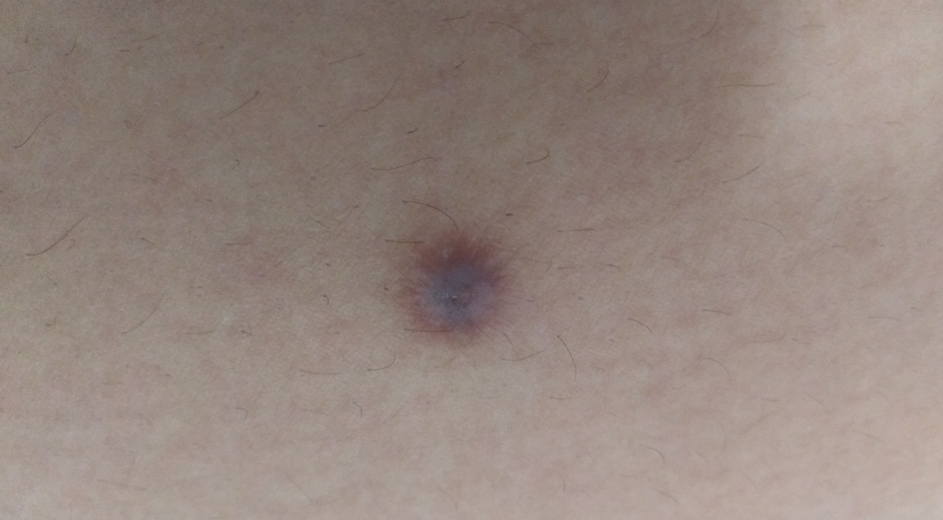 褐色皮肤纤维瘤会癌变吗,皮肤里面有个小的肿块会是什么